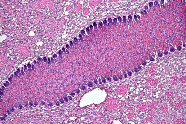Histology tissue section image showing hematoxylin and eosin staining of tumor tissue for digital pathology analysis